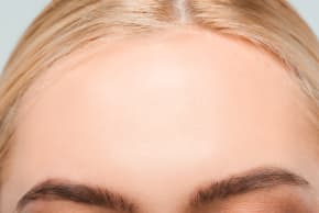 Forehead reduction surgery can reshape the hairline and facial proportions.