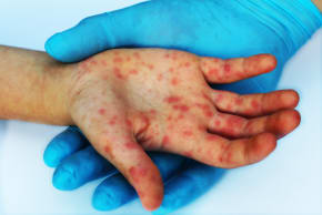 Measles infection (illustrative)