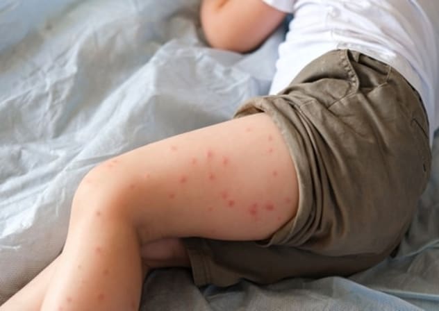 measles
