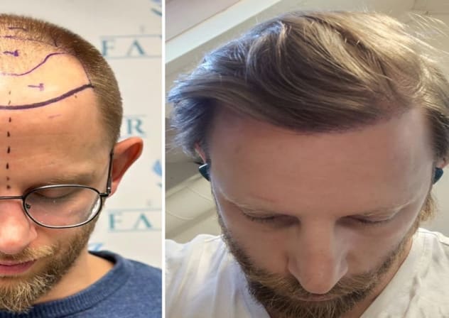 Turkey leads in affordable, high-quality FUE & DHI hair transplants with all-inclusive packages.