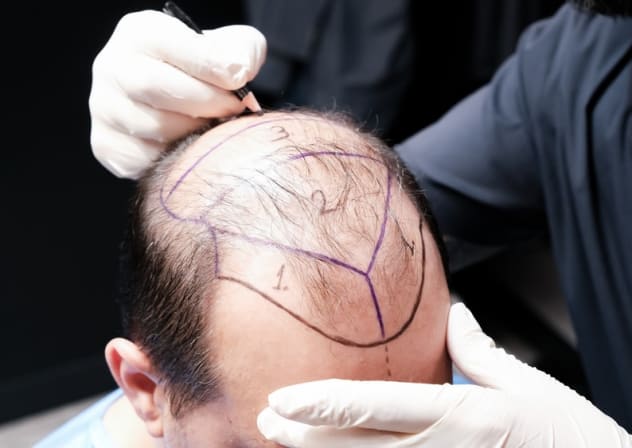 From Istanbul Care to established names, explore what to consider when comparing hair transplant clinics in Turkey.