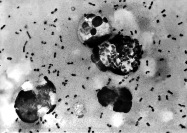  A bubonic plague smear, prepared from a lymph removed from an adenopathic lymph node, or bubo, of a plague patient, demonstrates the presence of the Yersinia pestis bacteria that causes the plague in this undated photo. 