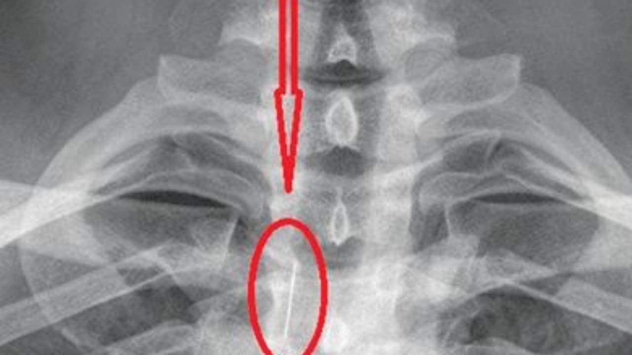 X ray w/ pin_150