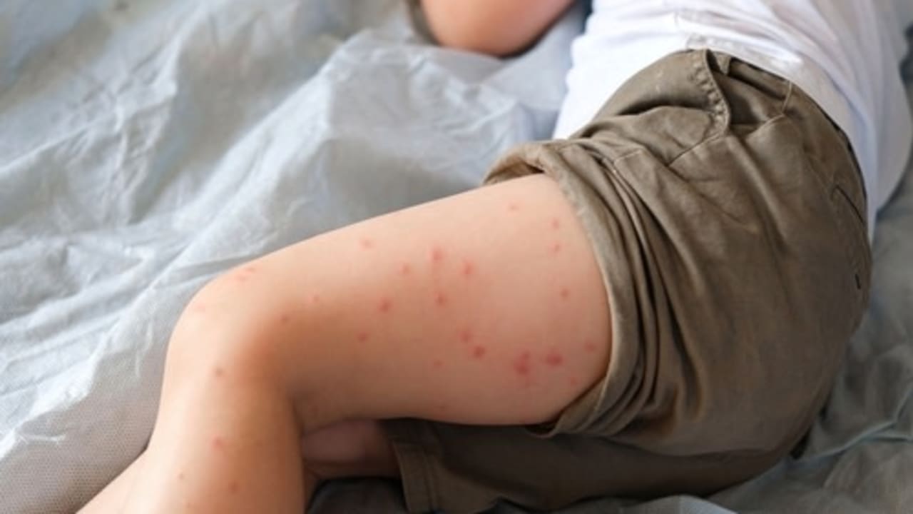 measles