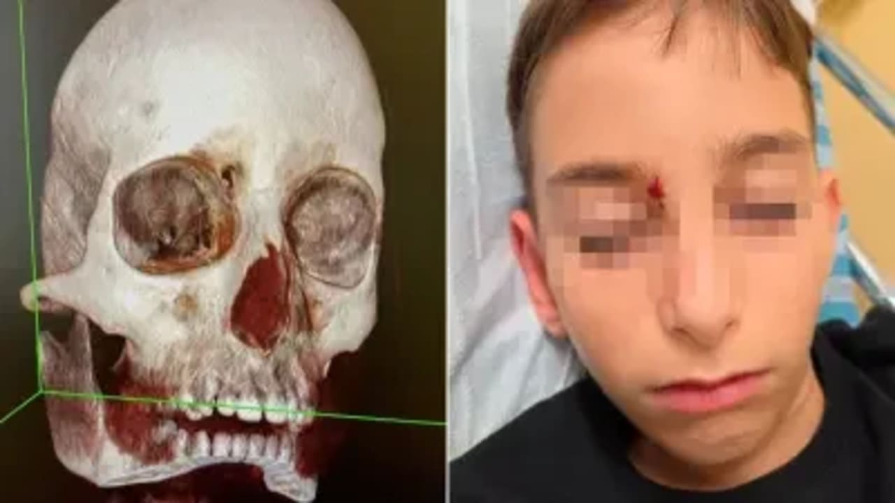 An 11-year-old was injured by an arrow to the head at camp in Israel. Images shared by the family.