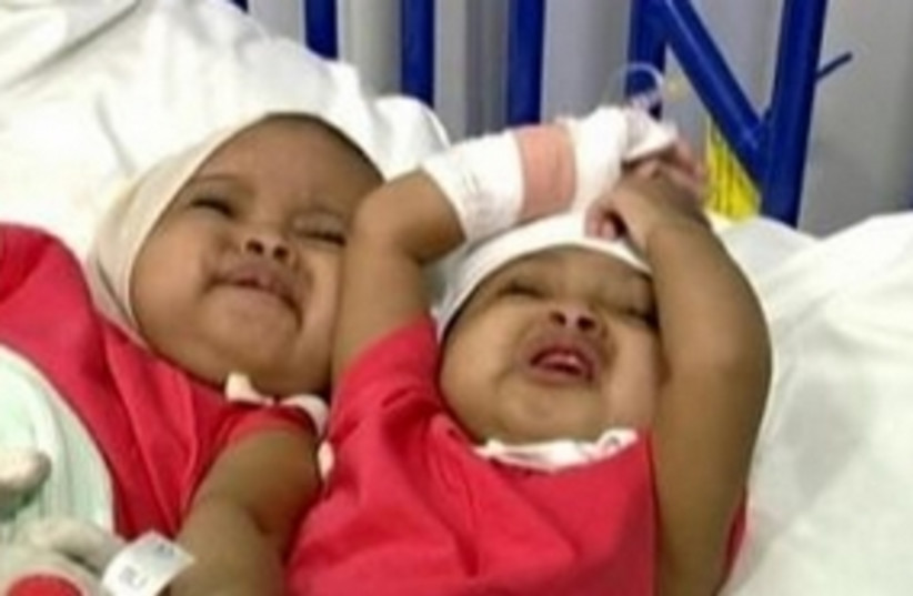 Sudanese conjoined twins (photo credit: Reuters)
