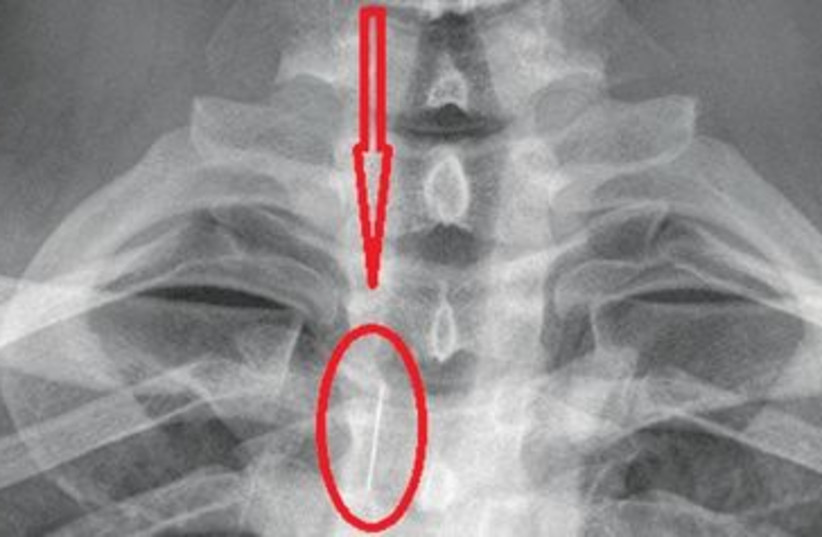 X ray w/ pin_150 (photo credit: Galilee Medical Faculty)