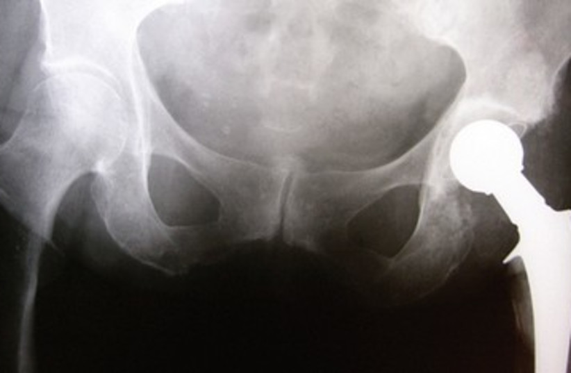 hip implant X-Ray [illustrative]_390 (photo credit: Thinkstock/Imagebank)