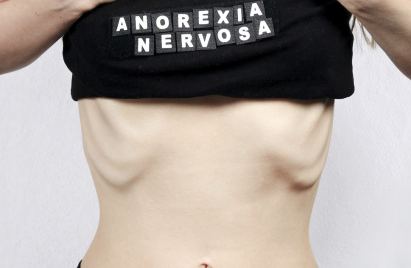 anorexia anorexic eating disorder skinny 150 (photo credit: iStockphoto)