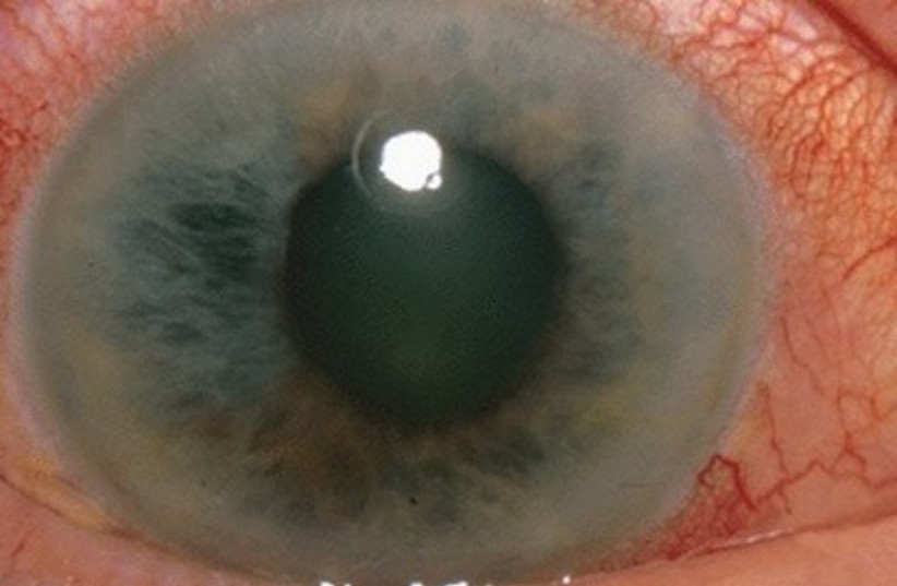 Glaucoma 390 (photo credit: Wikimedia Commons)