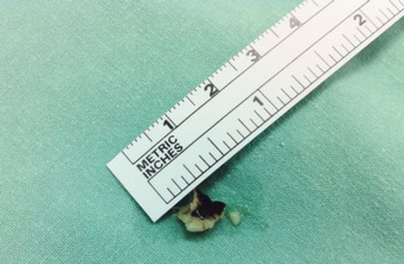 Walnut removed from bay's throat 370 (photo credit: Rambam Medical Center)