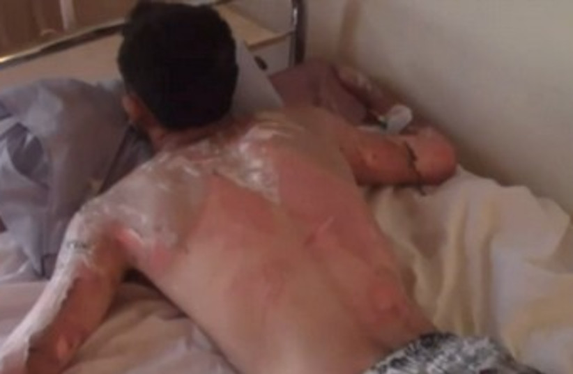 Syrian man with Napalm-like injuries 370 (photo credit: Video screenshot)