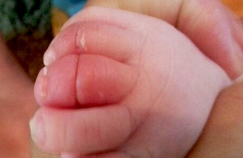 Babies mangled toes (photo credit: KAPLAN MEDICAL CENTER)