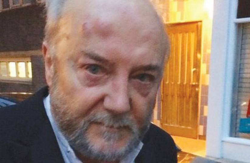 BRITISH MP George Galloway, heavily bruised, is shown after he was assaulted on a West London street on Friday (photo credit: TWITTER)