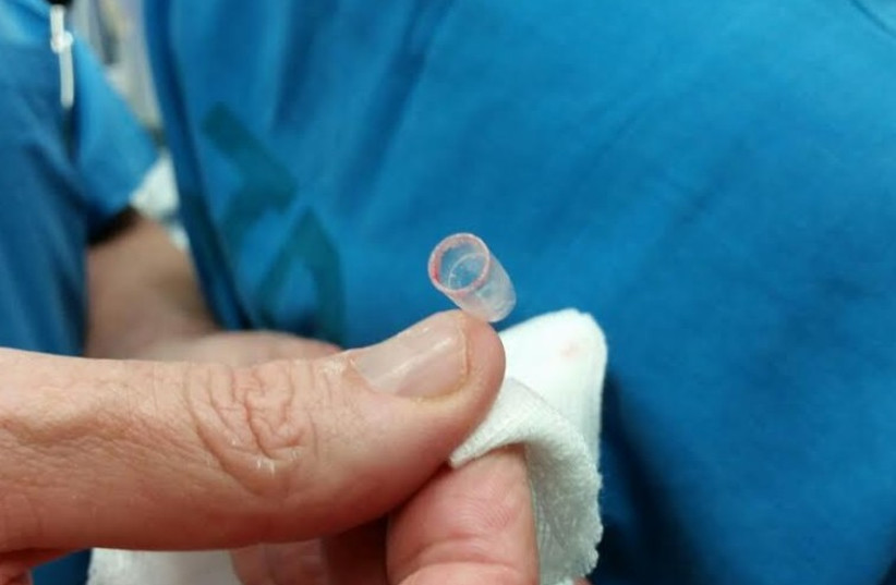 Pen cap removed from lung by doctors (photo credit: KAPLAN MEDICAL CENTER)