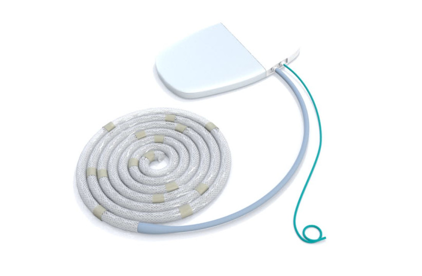 Paragate's Implantable Peritoneal Ultrafiltration device. (photo credit: PARAGATE MEDICAL)