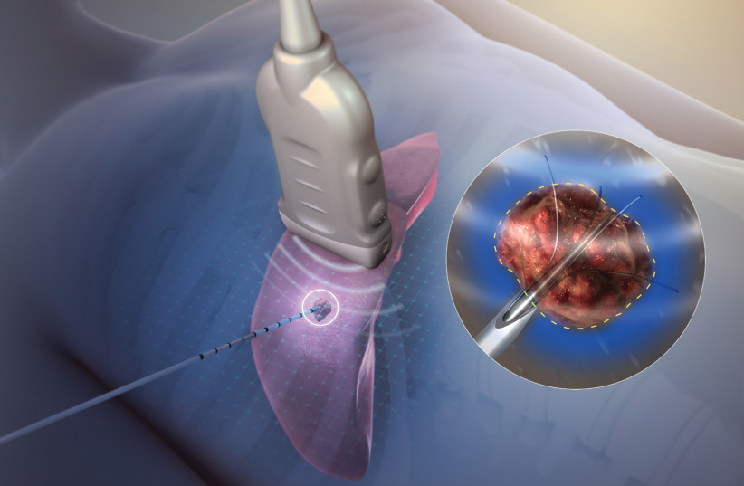 TECHSOMED'S SYSTEM removes the ‘blindfold’ in the thermal ablation cancer treatment, a minimally invasive procedure that basically ‘burns’ the cancer until it dies (photo credit: Courtesy)