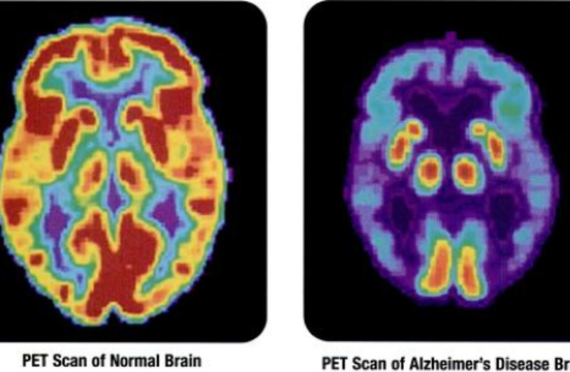 PET scans showing the differences between a healthy older adult's brain and the brain of an older adult afflicted with Alzheimer's Disease (photo credit: Wikimedia Commons)