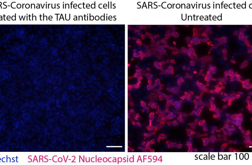 Microscopic imaging reveals a stark contrast between Sars-CoV-2 infected cells which were treated by the research team's antibody cocktail and those which were not. (credit: TEL AVIV UNIVERSITY)