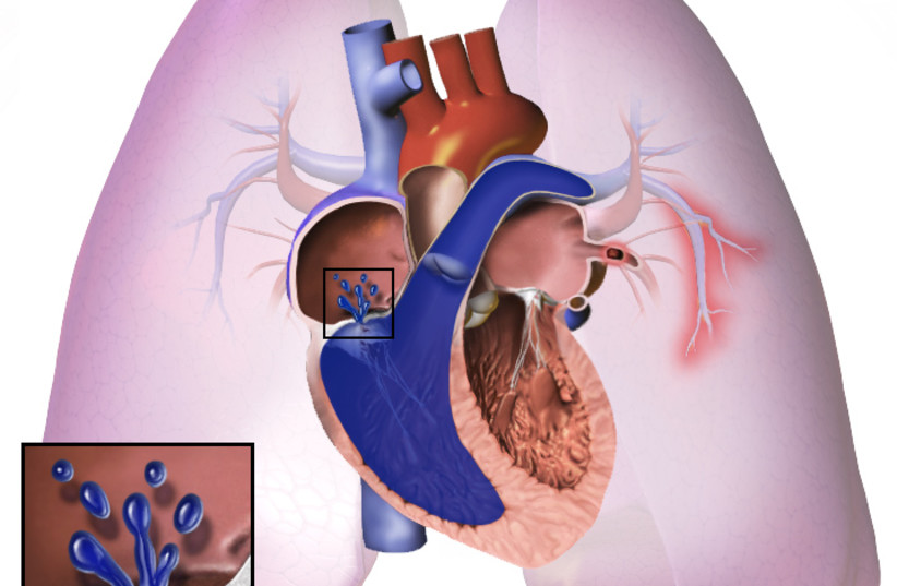 Pulmonary Hypertension (photo credit: Wikimedia Commons)