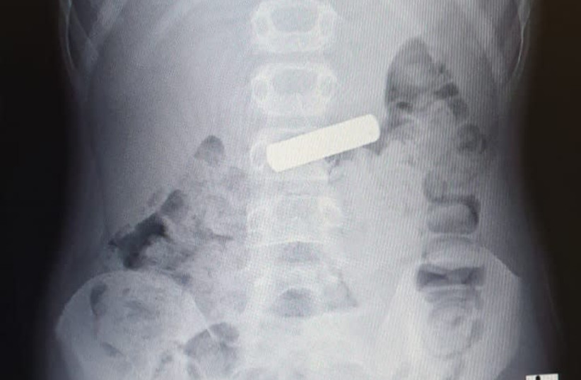 X-ray of the battery inside the seven-year-old's stomach.  (photo credit: Courtesy)