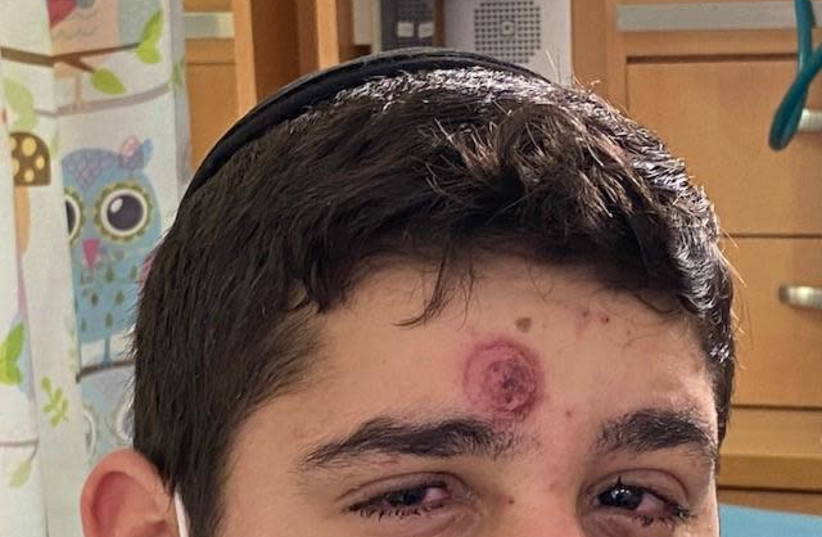 Ezra, 16, at Hadassah hospital after fireworks exploded in his face (photo credit: HADASSAH UNIVERSITY MEDICAL CENTER)