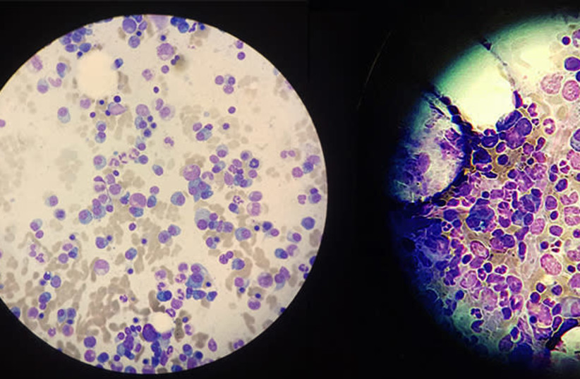Resistant multiple myeloma cells (violet-blue) in two samples, seen under a microscope (photo credit: WEIZMANN INSTITUTE OF SCIENCE)