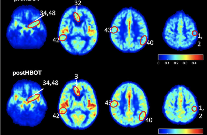  Study results show elevated blood flow and improved oxygenation in the brain of patients suffering from cognitive impairment (photo credit: Aging/Uri Ashery)