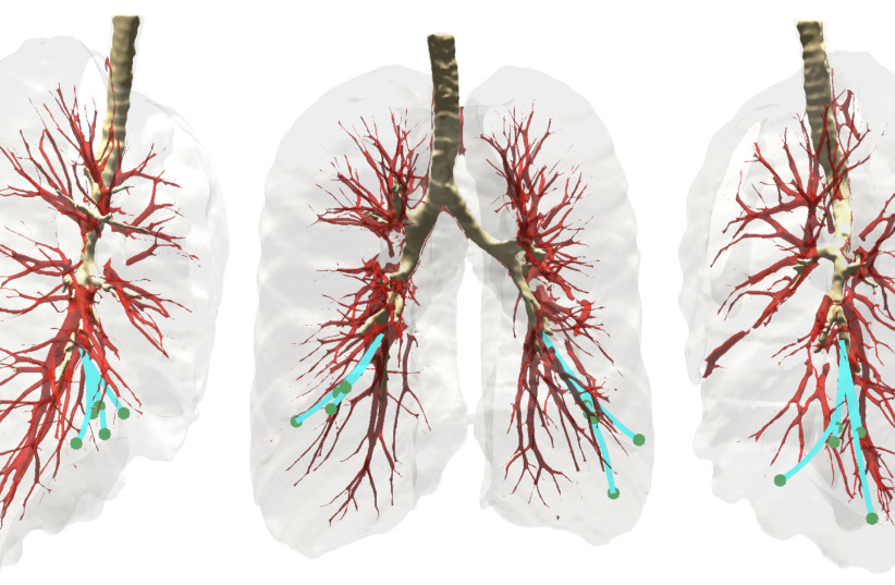 Three views of the lung environment. The needle steers to targets (green) while avoiding anatomical obstacles including large blood vessels (red), bronchial tubes (brown) and the lung boundary (gray). (photo credit: COURTESY TECHNION)