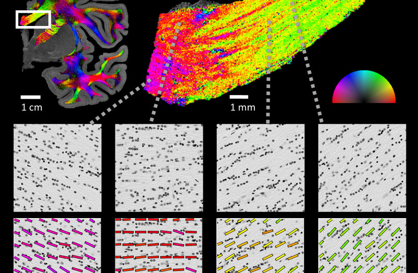  Top left: Results from running Nissel ST technique on a single slice from a human hemisphere. We can see the nerve fiber orientation map (the orientation is color-coded according to the half-circle on the right). Top right: Enlarged view of the nerve fiber orientation map in the white-matter tract  (photo credit: Roey Schurr)