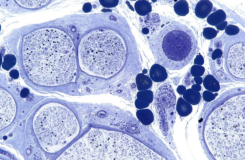  Intermediate magnification micrograph of a vasculitic neuropathy, also neuropathy due to a vasculitis. (photo credit: NEPHRON/WIKIMEDIA COMMONS)