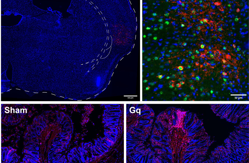  Insular neurons (in red) that were captured during colitis and reactivated (in green) upon recovery. Lower panel: Colon sections showing white blood cells (in red) present in the tissue of a mouse after insular neurons reactivation (Gq, right) and its non-activated control. (photo credit: NITZAN ZOHAR/TECHNION SPOKESPERSON'S OFFICE)