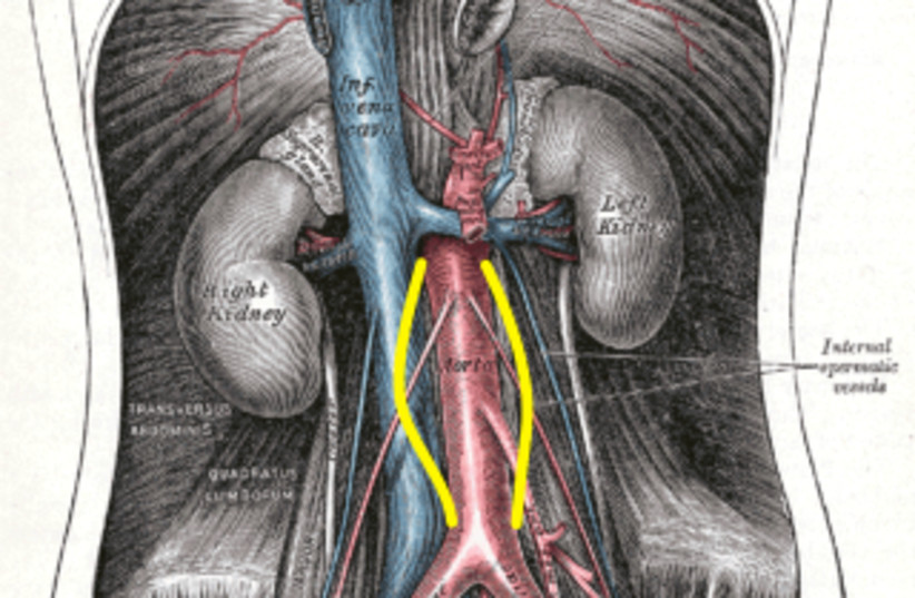 A plate from Gray's Anatomy with yellow lines depicting the most common infrarenal location of the AAA (credit: HENRY VANDYKE CARTER/PUBLIC DOMAIN/VIA WIKIMEDIA COMMONS)