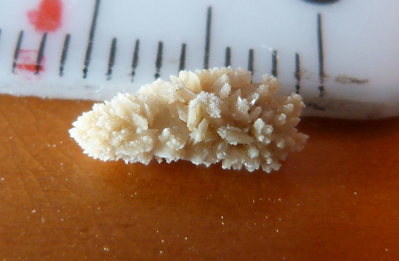  A kidney stone. These form from crystalized minerals in urine that cause severe pain when exiting the urinary tract (Illustrative). (credit: Wikimedia Commons)