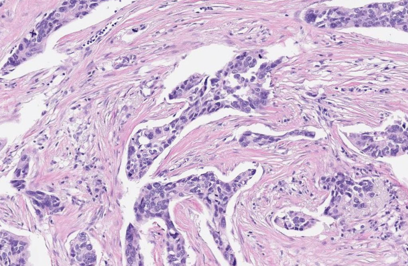 Scansiona le foto di un tumore;  in esso puoi vedere cellule cancerose che sono colorate in viola.  (credito: nucleare)