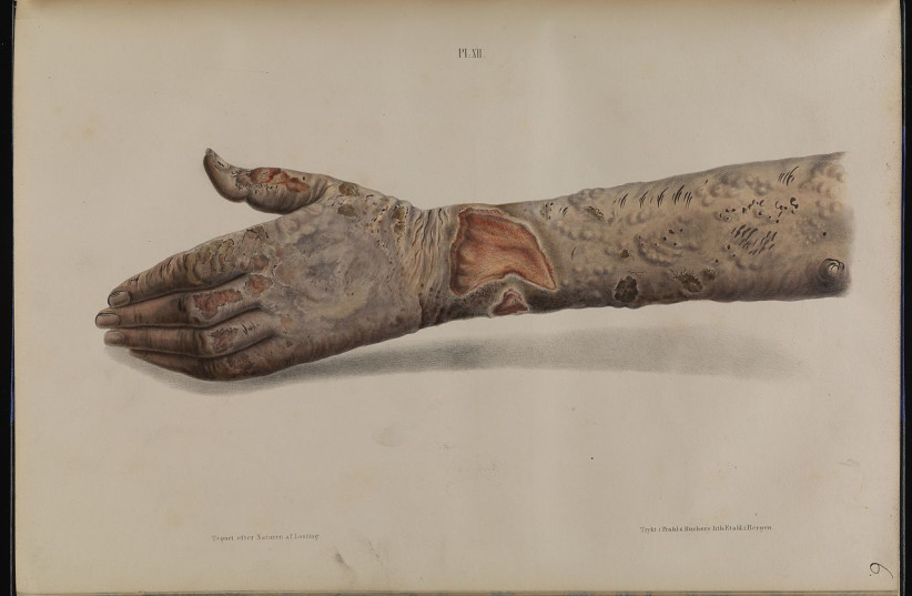  Tubercular leprosy on the hand and arm. (credit: Wikimedia Commons)