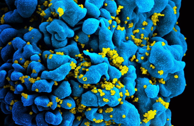  HIV-infected T-cell. (photo credit: WIKIMEDIA)