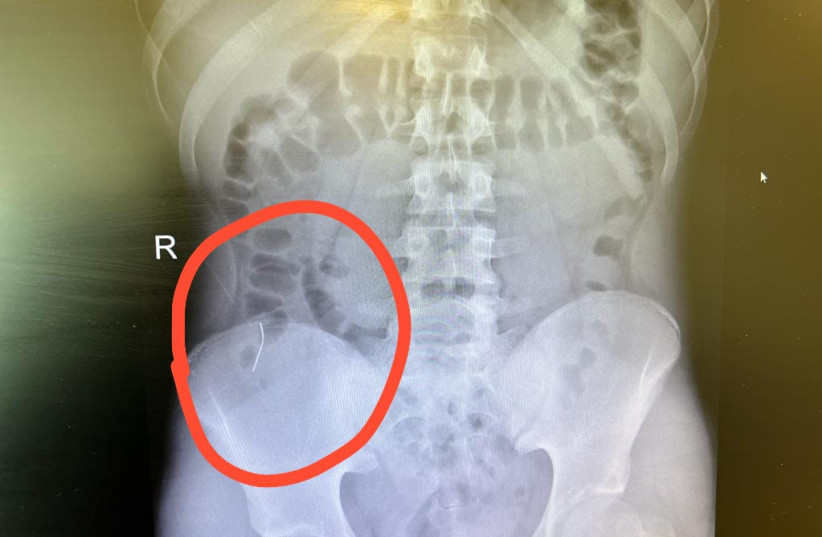  A needle got stuck inside a 14-year-old teen and was safely extracted.  (photo credit: RAMBAM HOSPITAL SPOKESMAN)