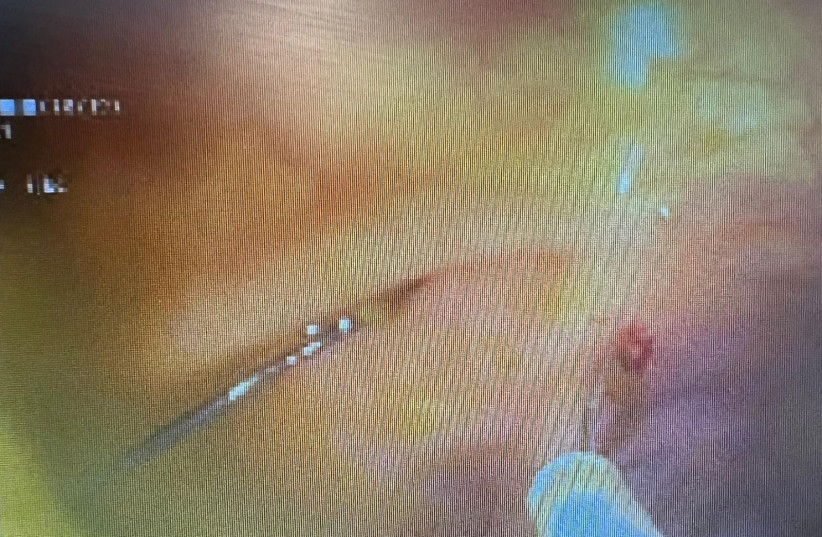 A needle got stuck inside a 14-year-old teen and was safely removed. (credit: RAMBAM HOSPITAL SPOKESMAN)
