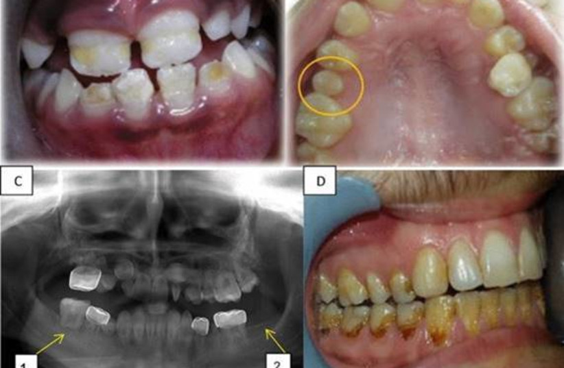  Long term dental effects. (credit: Elinor Halperson/Hebrew University-Hadassah School of Dental Medicine)