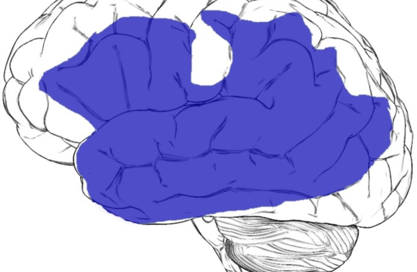  Global aphasia most commonly occurs due to a large lesion that encompasses much of the left hemisphere, specifically the left perisylvian cortex. (credit: Wikimedia Commons)