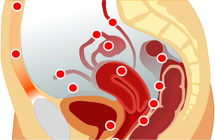 Localisation of endometriosis, illustrative.  (credit: Wikimedia Commons)