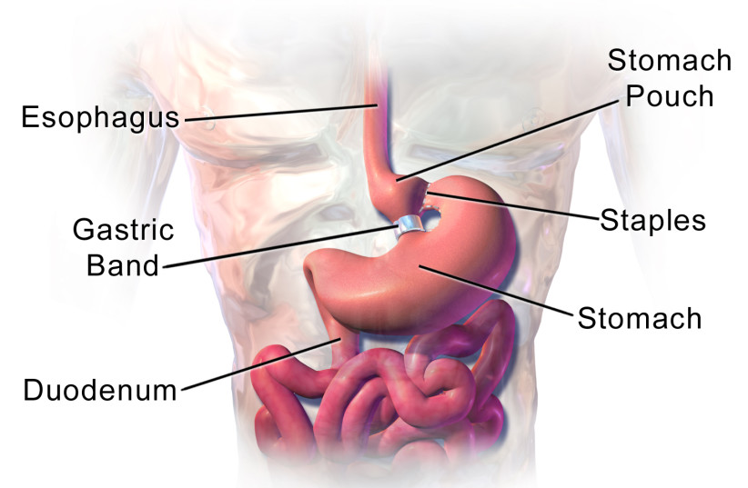 Diagram of a gastric bypass surgery  (credit: Wikimedia Commons)