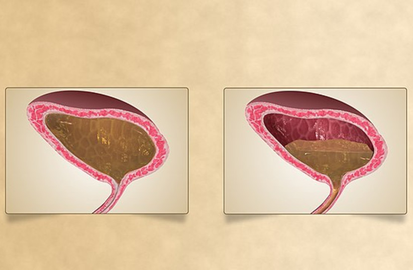  3D medical animation still showing normal urinary bladder(L) and overactive urinary bladder(R). (credit: Wikimedia Commons)