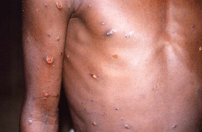  An image created during an investigation into an outbreak of monkeypox, which took place in the Democratic Republic of the Congo, 1996 to 1997, shows the arms and torso of a patient with skin lesions due to monkeypox. (photo credit: CDC/Brian W.J. Mahy/Handout via REUTERS)
