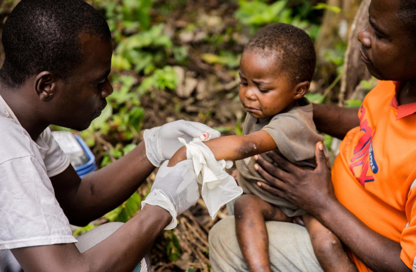  A child affected by monkeypox, sits on his father's legs while receiving treatment at the centre of the International medical NGO Doctors Without Borders (Medecins sans frontieres - MSF), in Zomea Kaka, in the Lobaya region, in the Central African Republic on October 18, 2018.  (photo credit: CHARLES BOUESSEL/AFP via Getty Images)