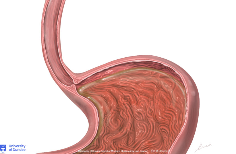  Healthy Esophagus and Stomach. (credit: TILT UNIVERSITY OF DUNDEE, SCHOOL OF MEDICINE/FLICKR)