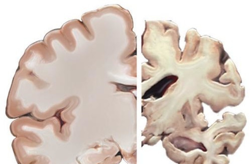  A healthy brain compared to a brain suffering from Alzheimer's Disease (photo credit: National Institutes of Health)