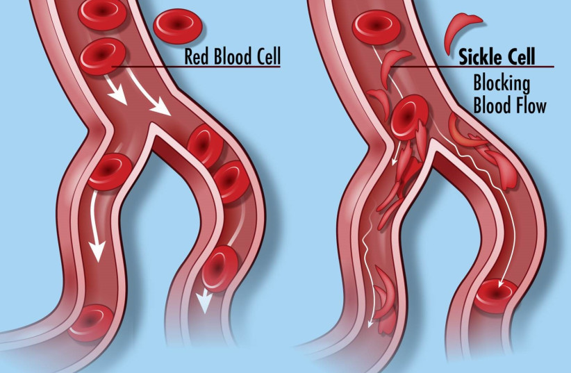  Sickle cell anemia (photo credit: Wikimedia Commons)