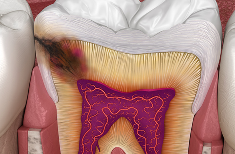  The acid produced by the bacteria damages the tooth enamel and the dentin layer that coats the tooth, until a cavity is formed. Illustration of a tooth cavity. (credit: Alex Mit/Shutterstock)